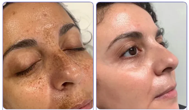 ЕХТЕRМIΝАDОR DЕ RUGАЅ