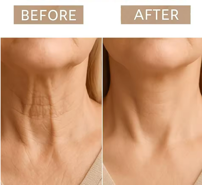 LiftNeck - Adesivo para rugas e flacidez pescoço