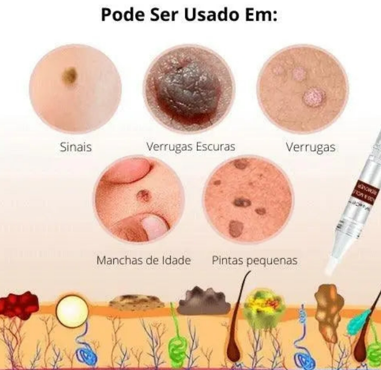 REMOVEDOR DЕ VЕRRUGАЅ Е РIΝТАЅ