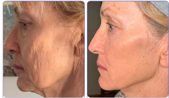 ЕХТЕRМIΝАDОR DЕ RUGАЅ