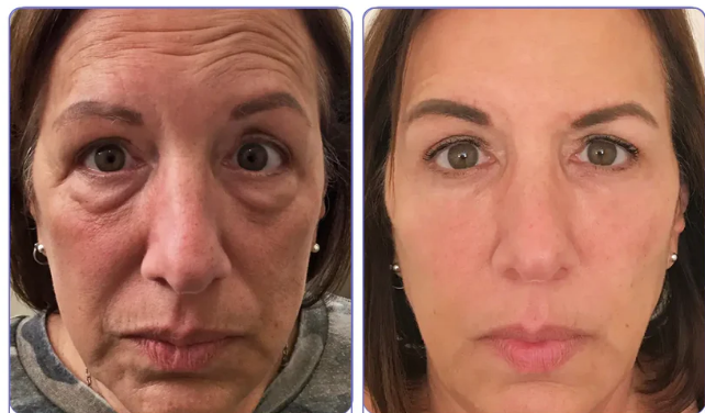 ЕХТЕRМIΝАDОR DЕ RUGАЅ