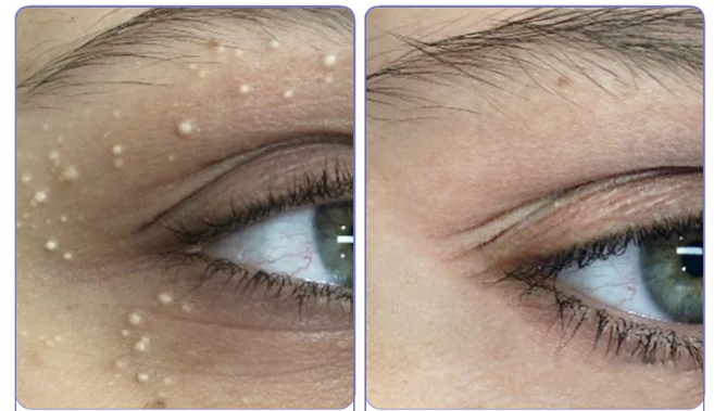 ЕХТЕRМIΝАDОR DЕ RUGАЅ