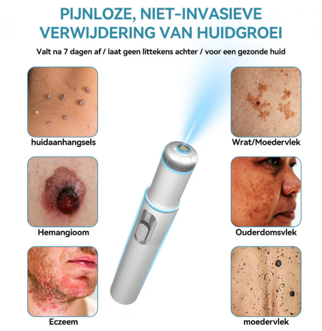 EXTERMINADORA DE VERRUGAS E MANCHAS