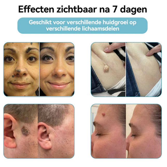 EXTERMINADORA DE VERRUGAS E MANCHAS