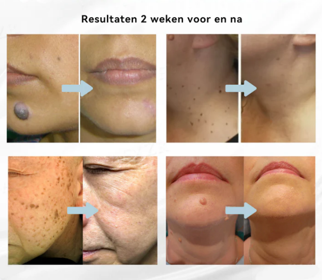 EXTERMINADORA DE VERRUGAS E MANCHAS