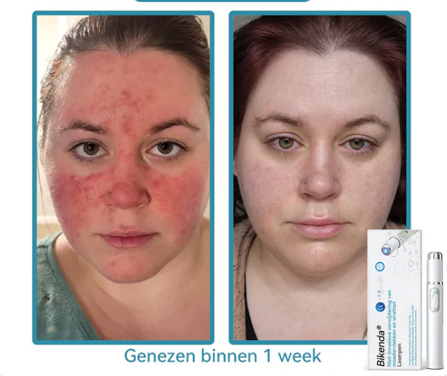 EXTERMINADORA DE VERRUGAS E MANCHAS