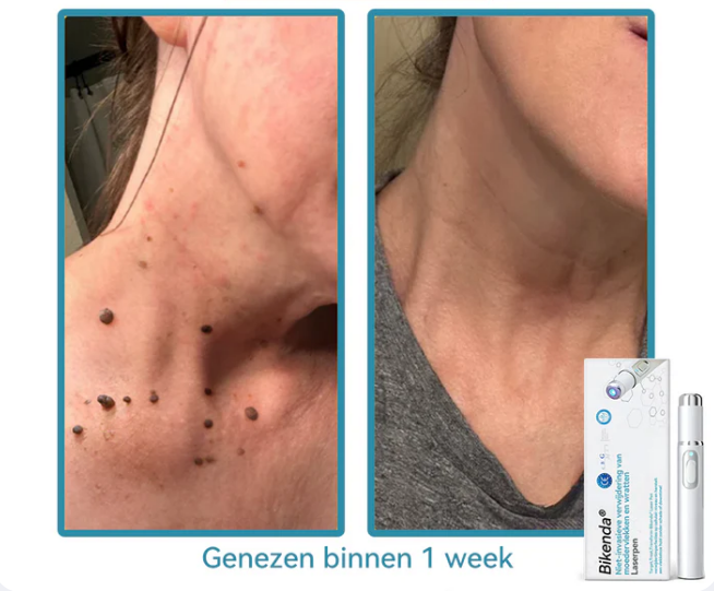 EXTERMINADORA DE VERRUGAS E MANCHAS