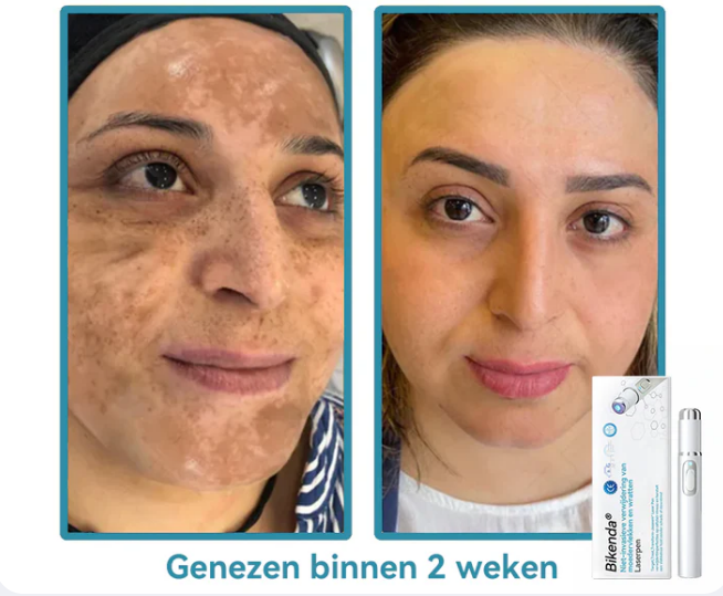 EXTERMINADORA DE VERRUGAS E MANCHAS