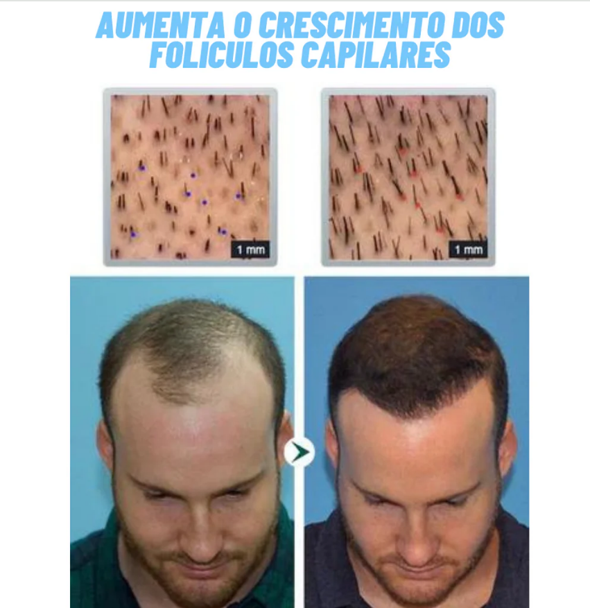Hair Revive - Revolução do Transplante capilar