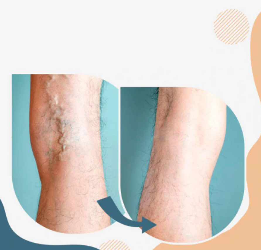 VARICOSE VEINS
